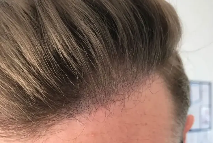 Scalp micropigmentation close-up result showing natural hair follicle replication