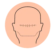 Scar Camouflage - Scalp micropigmentation result