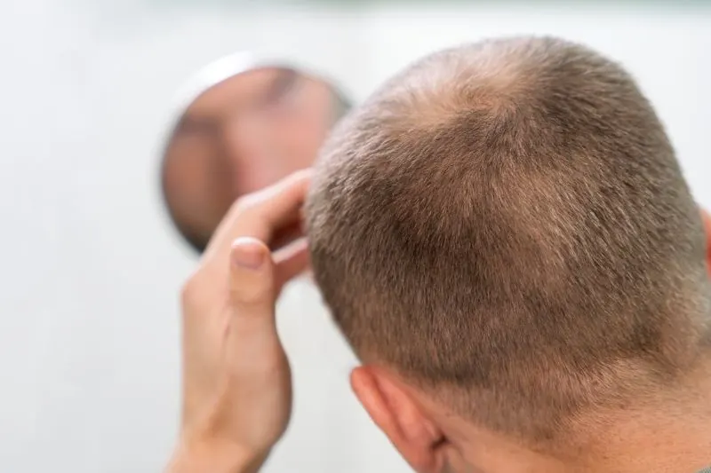 Hair loss solution - Scalp micropigmentation at Scalp & Art Nottingham