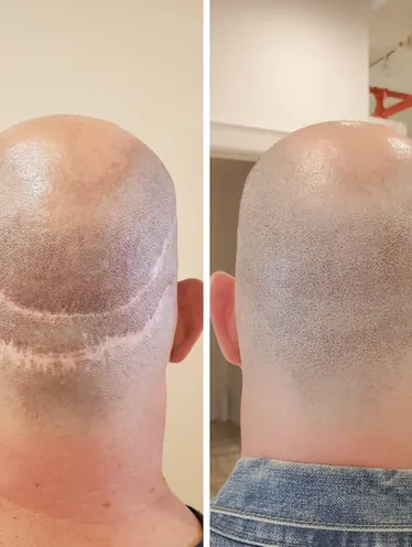 SMP for Hair Transplant Scars treatment at Scalp & Art Nottingham