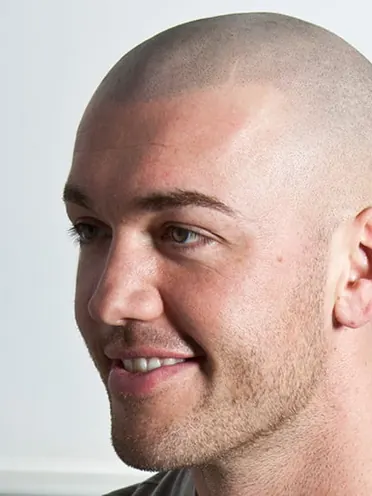 Scalp Micropigmentation treatment at Scalp & Art Nottingham