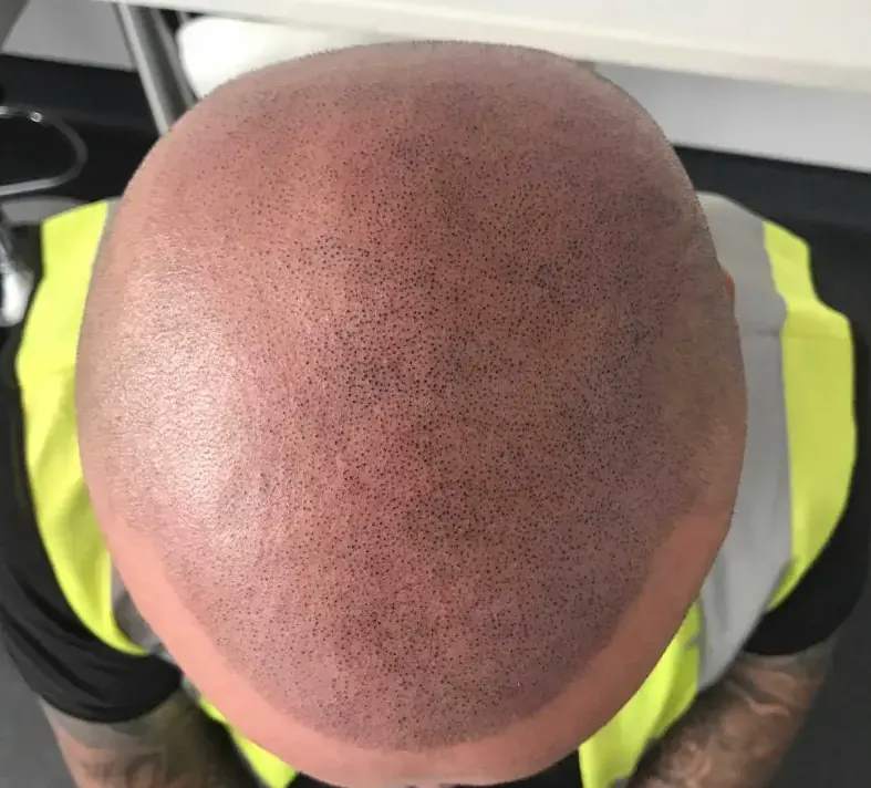 Scalp micropigmentation treatment result showing natural density